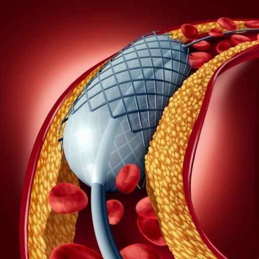 Angioplasty Angioplasty Treatment by Dr. Nikhil Patil